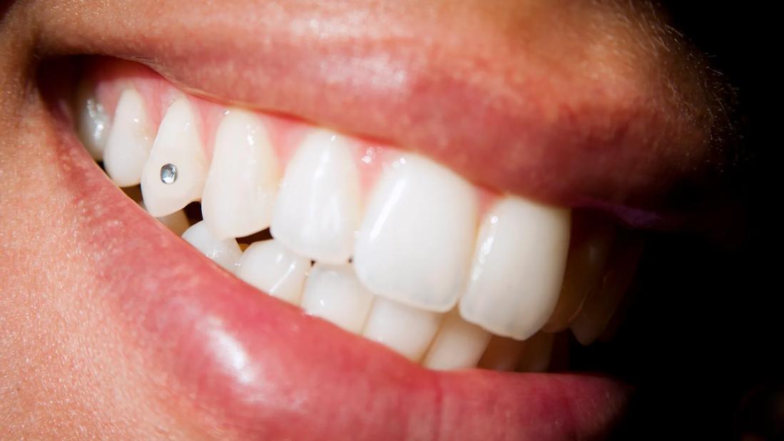 Close-up of a sparkling tooth gem on a canine tooth